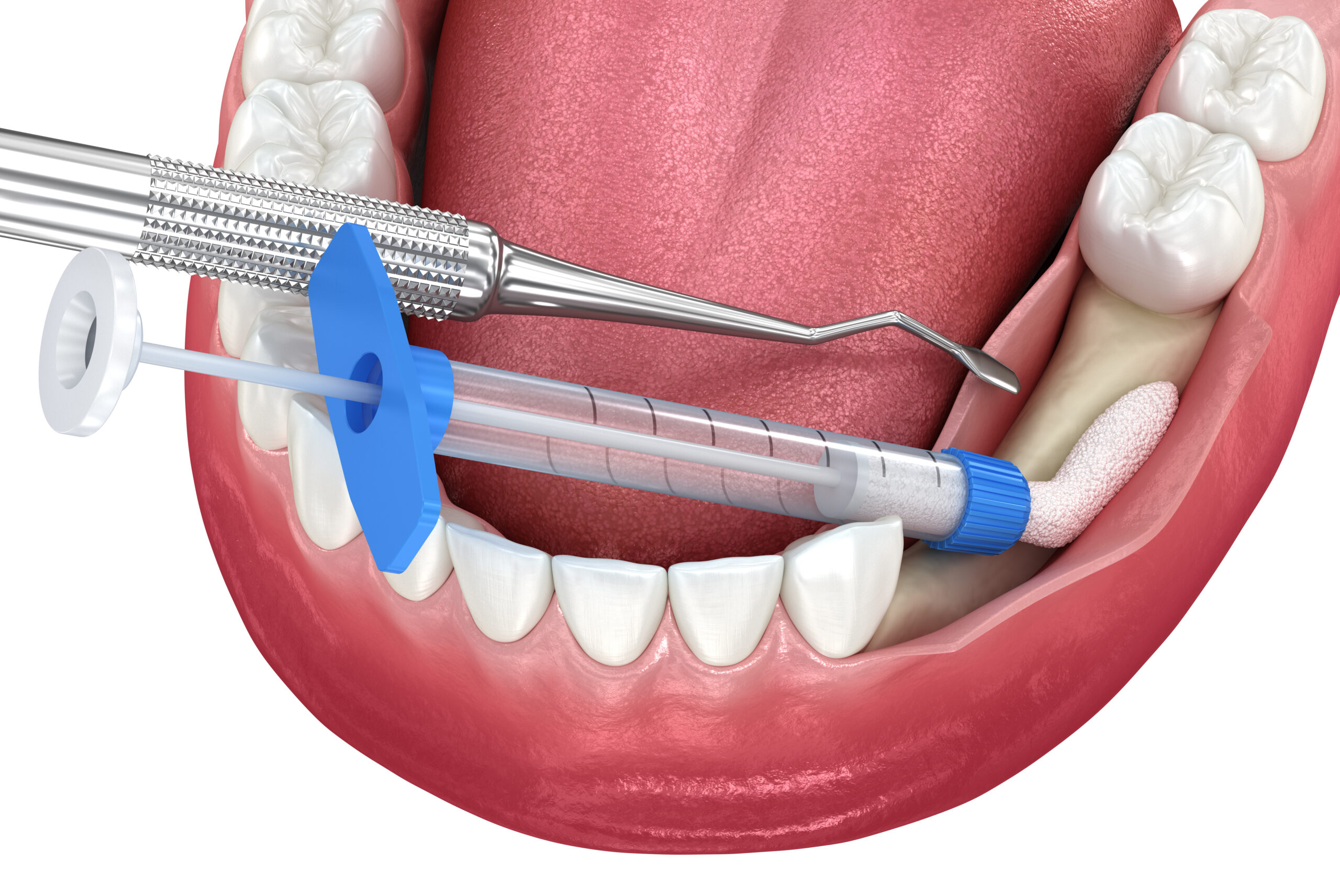 Bone grafting augmentation for tooth implantation. Medically accurate 3D illustration.